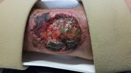 Shawn's hand healing after his UTV crash