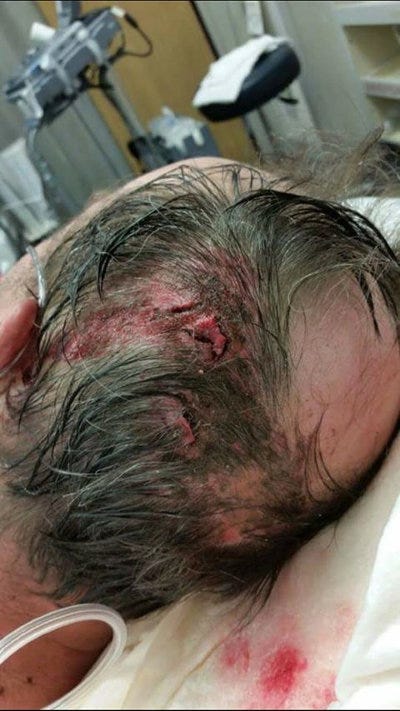 Shawn's head wound before stapling it.