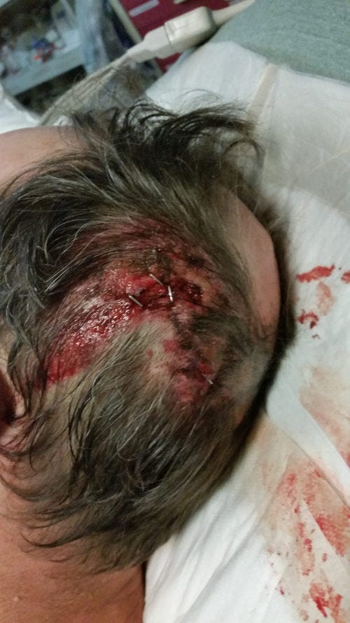 Staples in his head wound