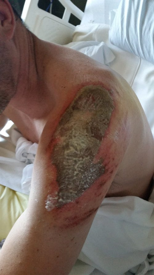 Road rash healing after his UTV crash