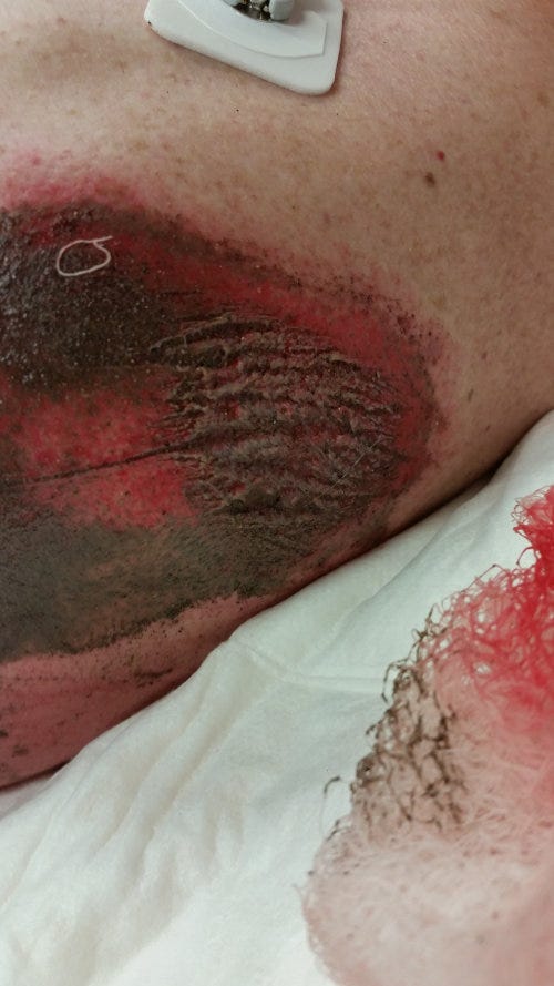 Fresh, dirty road rash hours after the UTV crash