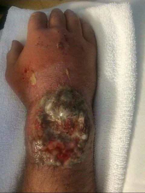 Shawn's hand starting to heal after his UTV accident